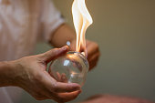 Woman preparing glass cup with flame for cupping therapy, a treatment used in Traditional Chinese Medicine (TCM) for pain relief and other health benefits.