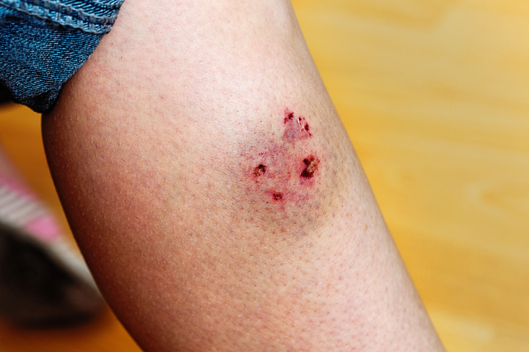 Dog bite leaves puncture marks and bruise on woman's leg Dog bite leaves puncture marks and bruise on woman's leg