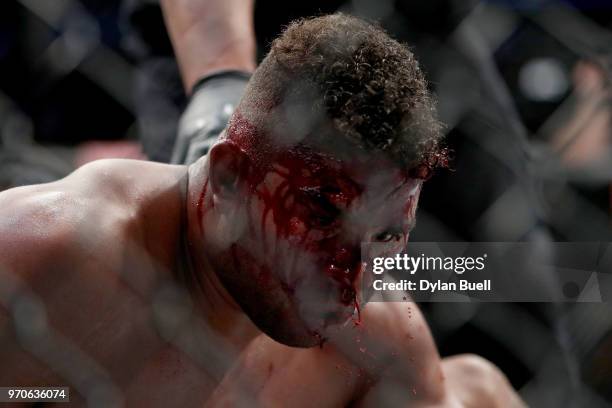 Blood drips from the face of Alistair Overeem of England after his match against Curtis Blaydes in their heavyweight bout during the UFC 225:...