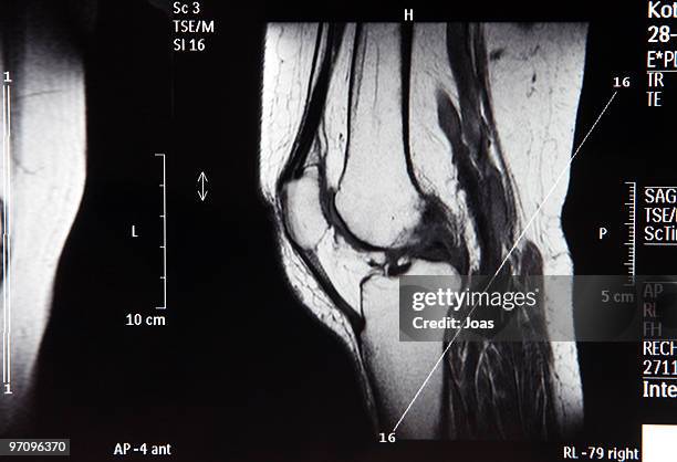genou humain 2 - bone cancer photos et images de collection