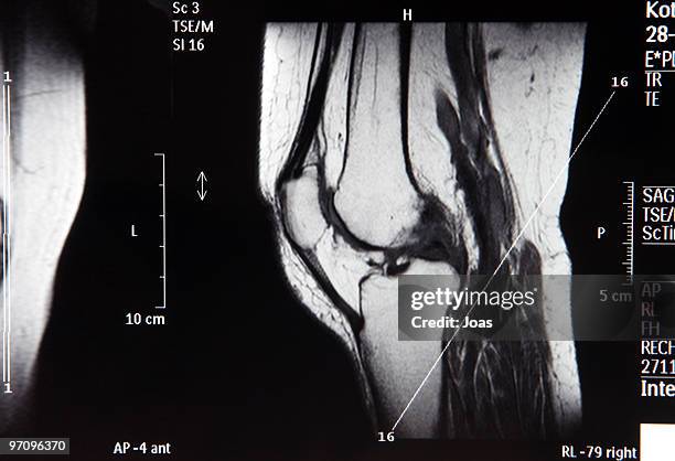 human knee 2 - meniscus stock pictures, royalty-free photos & images