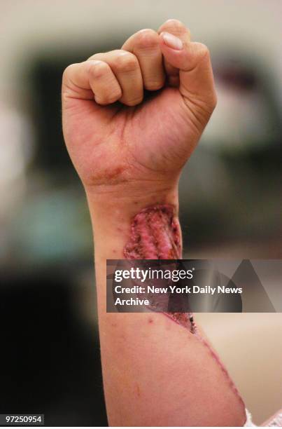 Army Sgt. Anesi Tuufuli, taking a break from physical therapy at Brooke Army Medical Center in Texas, displays one of the numerous injuries he...