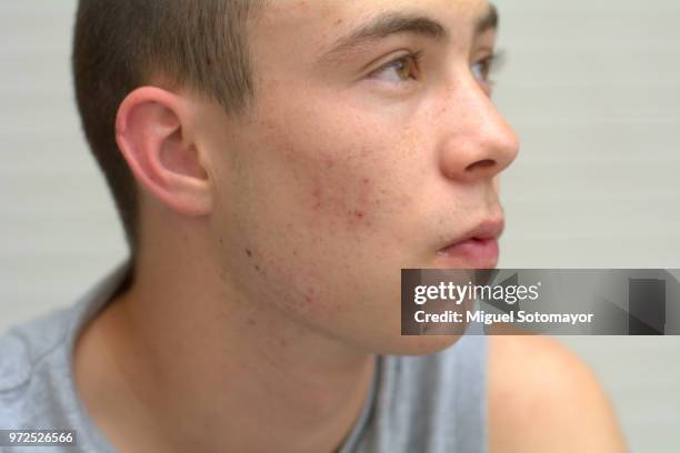 teenager with acne having breakfast - écorce photos et images de collection