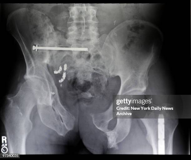 Ray of the pelvis of Firefighter Matt Long at NewYork-Presbyterian Hospital. Long is running in the NY Marathon after an accident where he was never...