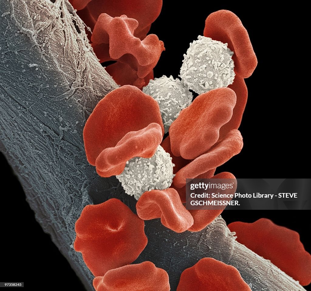 Leukaemia blood cells, SEM