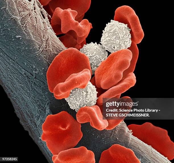 leukaemia blood cells, sem - micrografía electrónica escaneadora fotografías e imágenes de stock