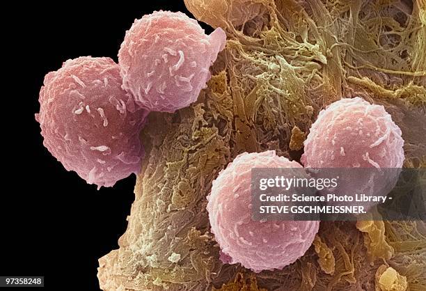 leukaemia blood cells, sem - micrografia elettronica a scansione foto e immagini stock