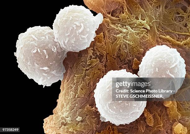 leukaemia blood cells, sem - micrografía electrónica escaneadora fotografías e imágenes de stock