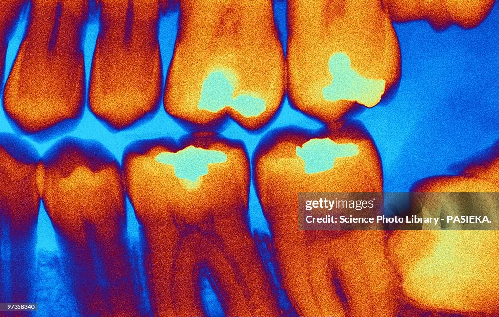 Teeth with fillings, X-ray