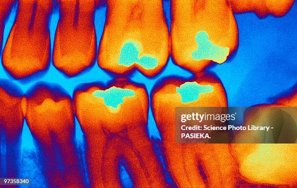 teeth with fillings, x-ray - dental filling stockfoto's en -beelden