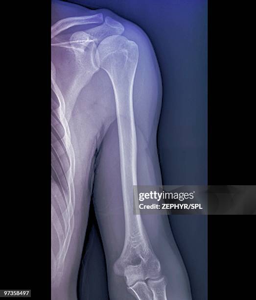 normal shoulder joint, x-ray - escapula fotografías e imágenes de stock