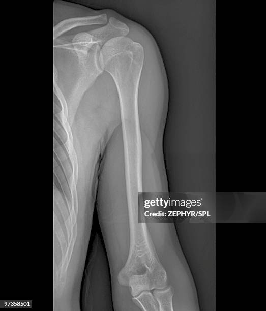 normal shoulder and elbow joints, x-ray - escapula fotografías e imágenes de stock
