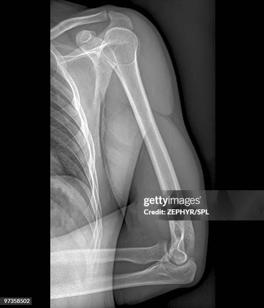 normal shoulder and elbow joints, x-ray - x ray arm stock pictures, royalty-free photos & images