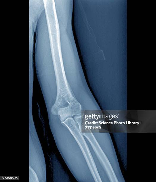 normal elbow joint, x-ray - 橈骨 ストックフォトと画像