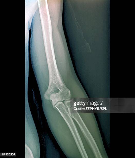 normal elbow joint, x-ray - 橈骨 ストックフォトと画像