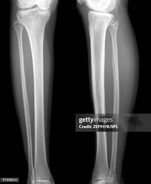 normal lower legs, x-ray - tibia photos et images de collection