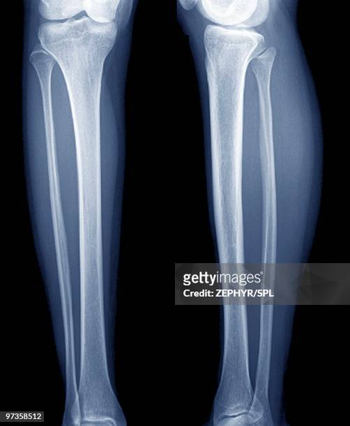 normal lower legs, x-ray - fibula foto e immagini stock
