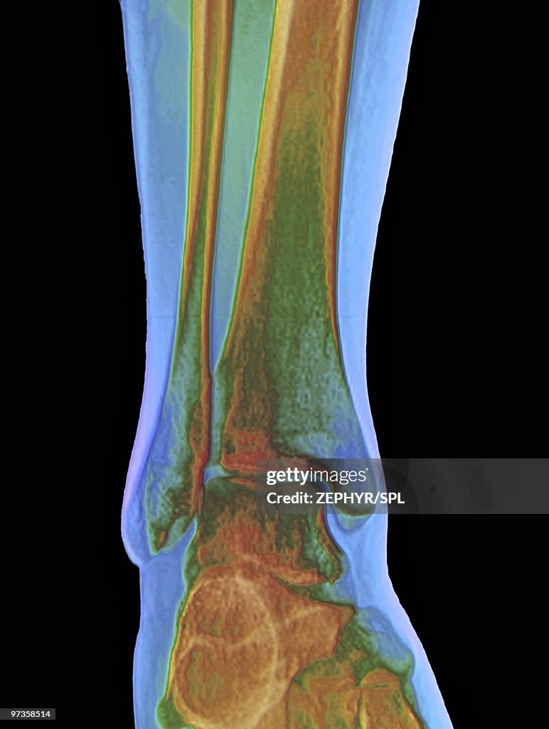 Normal ankle joint, X-ray