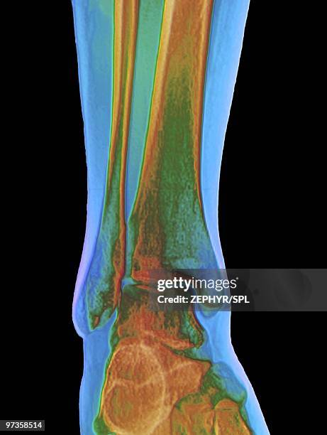 normal ankle joint, x-ray - fibula stock pictures, royalty-free photos & images