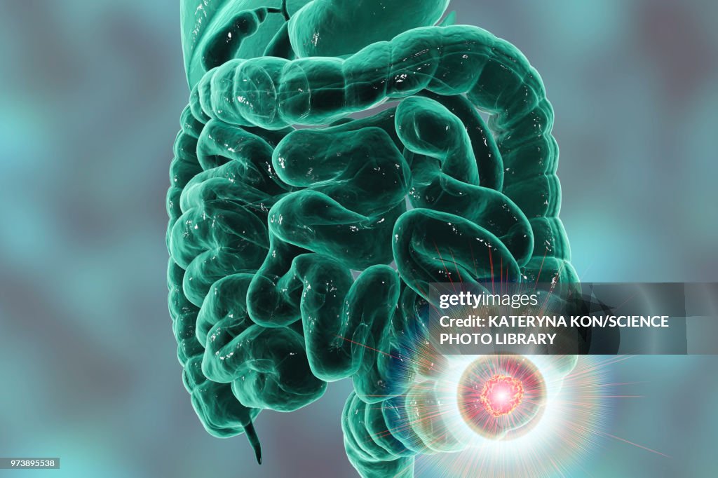Colon cancer treatment, conceptual illustration