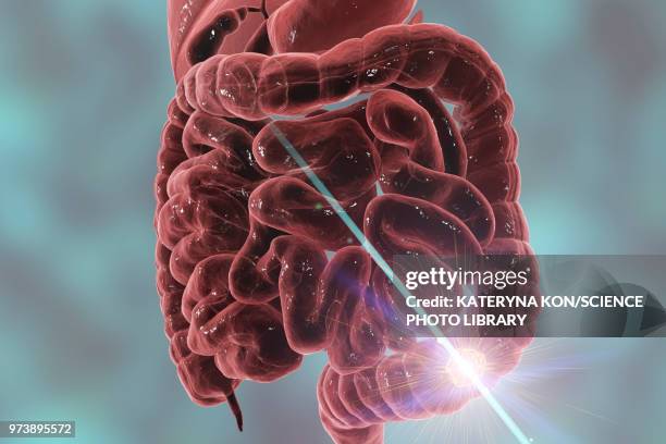 colon cancer treatment, conceptual illustration - radiotherapy stock illustrations