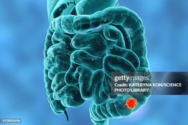 colon cancer, illustration - dickdarm verdauungstrakt stock-grafiken, -clipart, -cartoons und -symbole