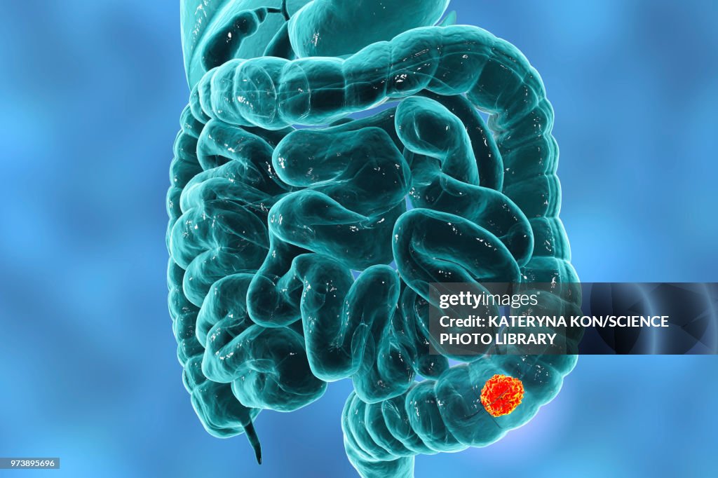 Colon cancer, illustration