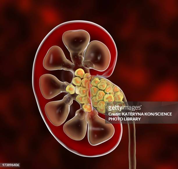illustrazioni stock, clip art, cartoni animati e icone di tendenza di kidney stones, illustration - kidney stone