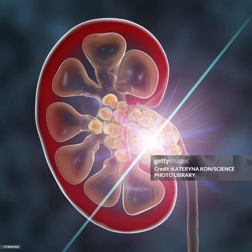 Kidney stone treatment, conceptual illustration