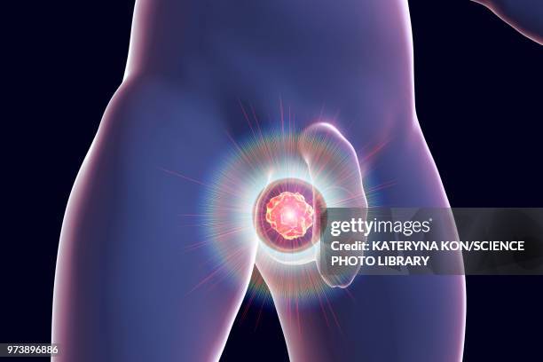 testicular cancer treatment, illustration - gesticular stock illustrations