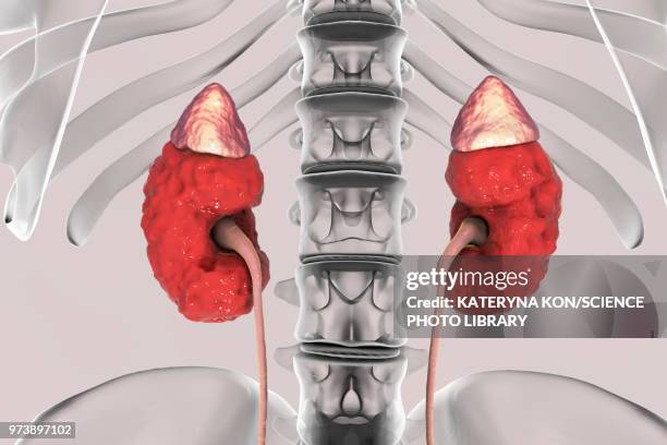 chronic kidney disease, illustration - cyst stock illustrations