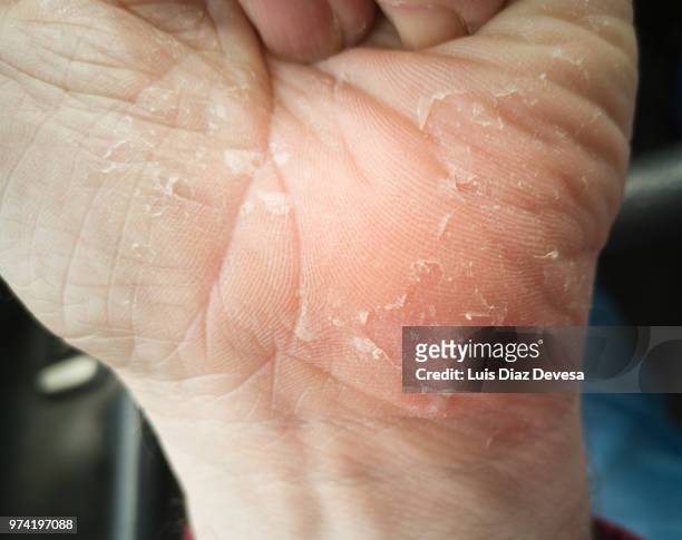 man with cracked skin - agaricus silvaticus stock pictures, royalty-free photos & images