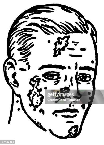 a black and white version of an illustration of an infected man - leprosy stock-grafiken, -clipart, -cartoons und -symbole