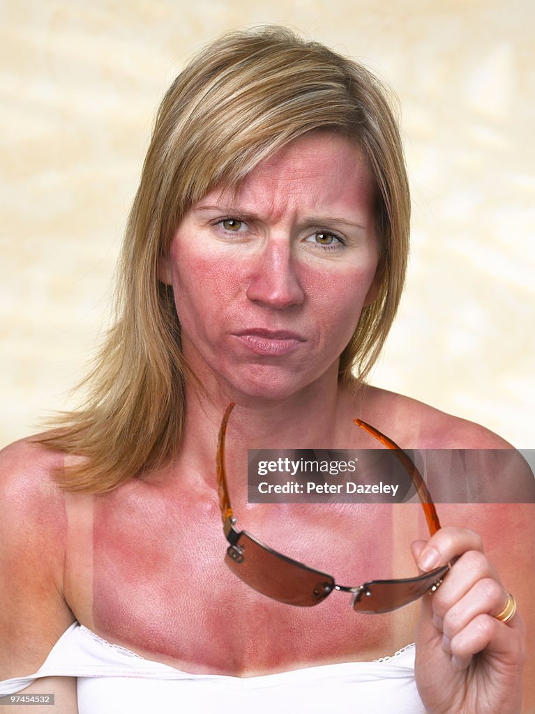 35 year old woman with sunburn