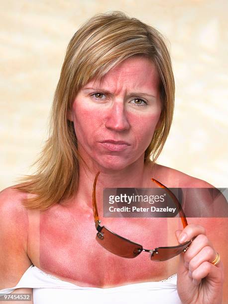 35 year old woman with sunburn - sunburned stockfoto's en -beelden