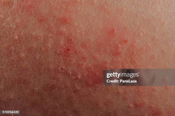 dermatitis eczema texture of ill human skin - psoriasis skin stock pictures, royalty-free photos & images
