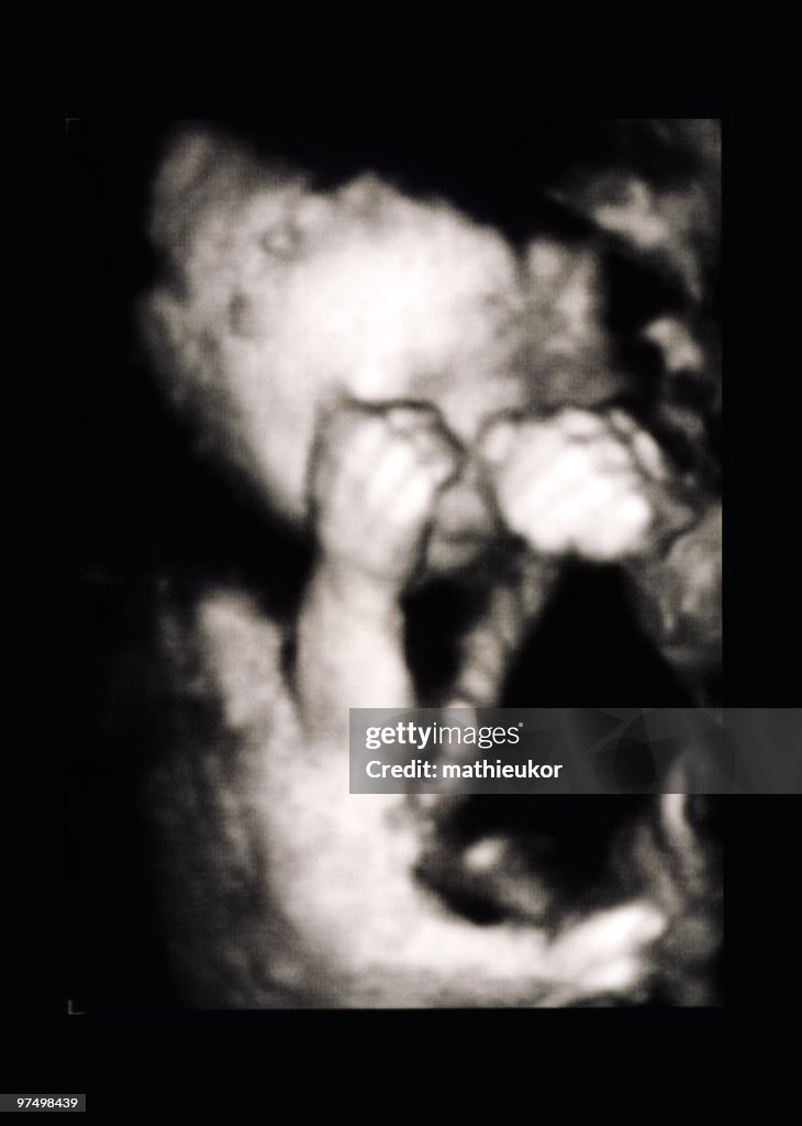 Fetus ultrasound (3D image)