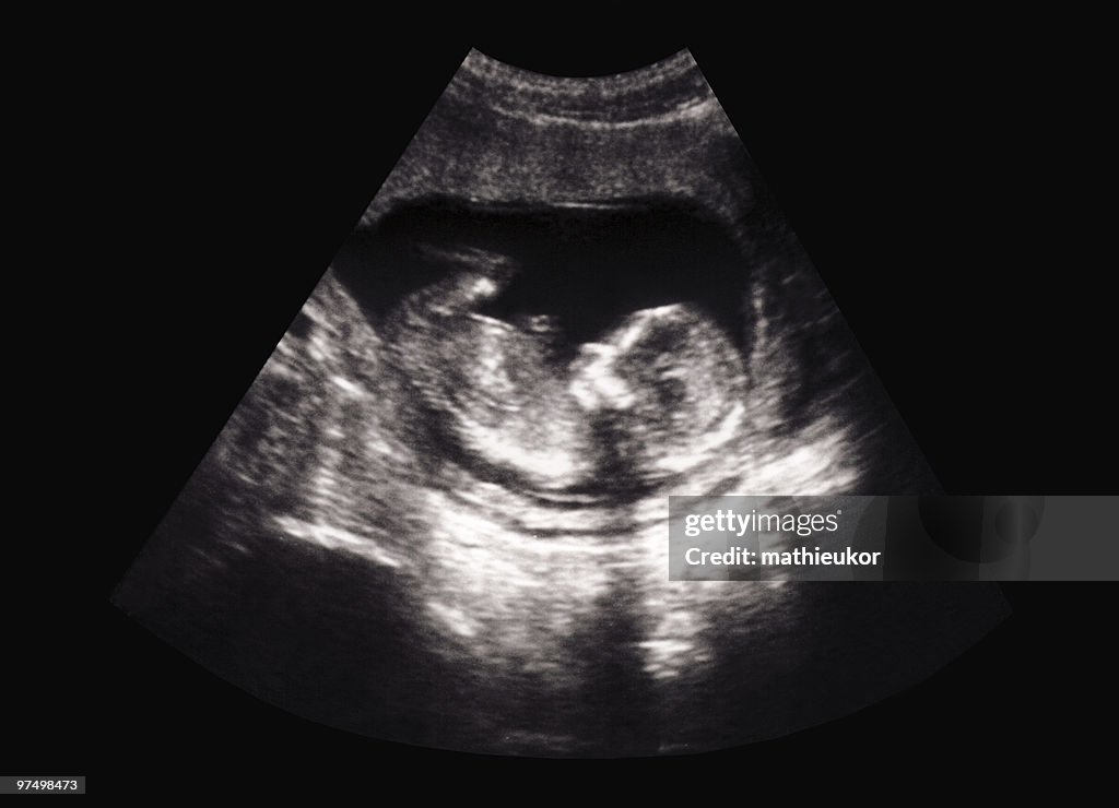 Fetus ultrasound