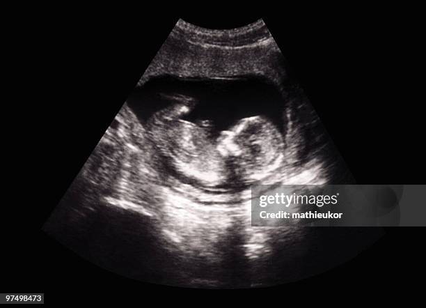 fetus ultrasound - ultraljud bildbanksfoton och bilder