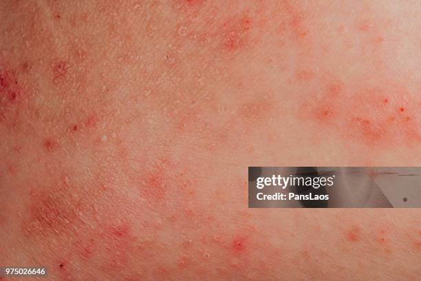 atopic eczema allergy texture of ill human skin - hautausschlag stock-fotos und bilder