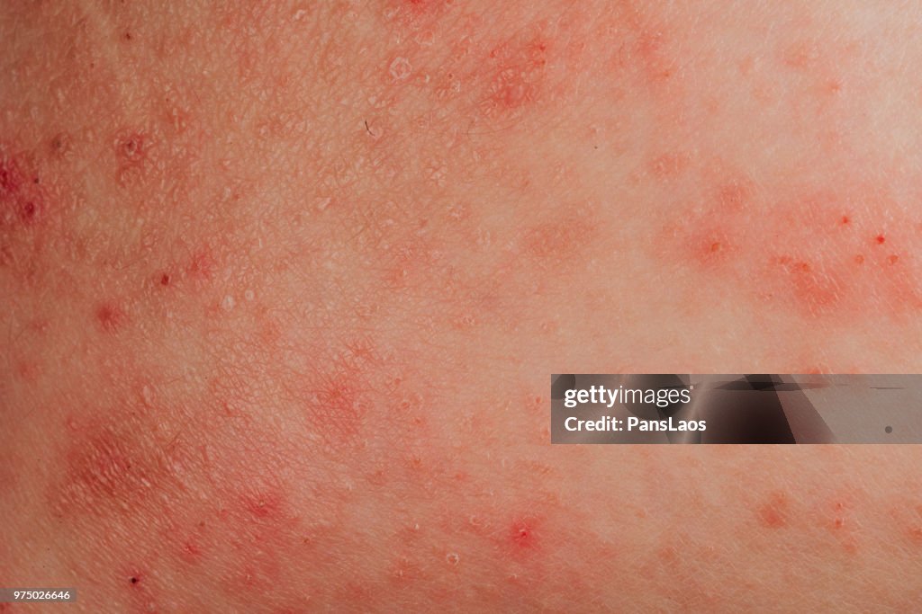 Atopic eczema allergy texture of ill human skin