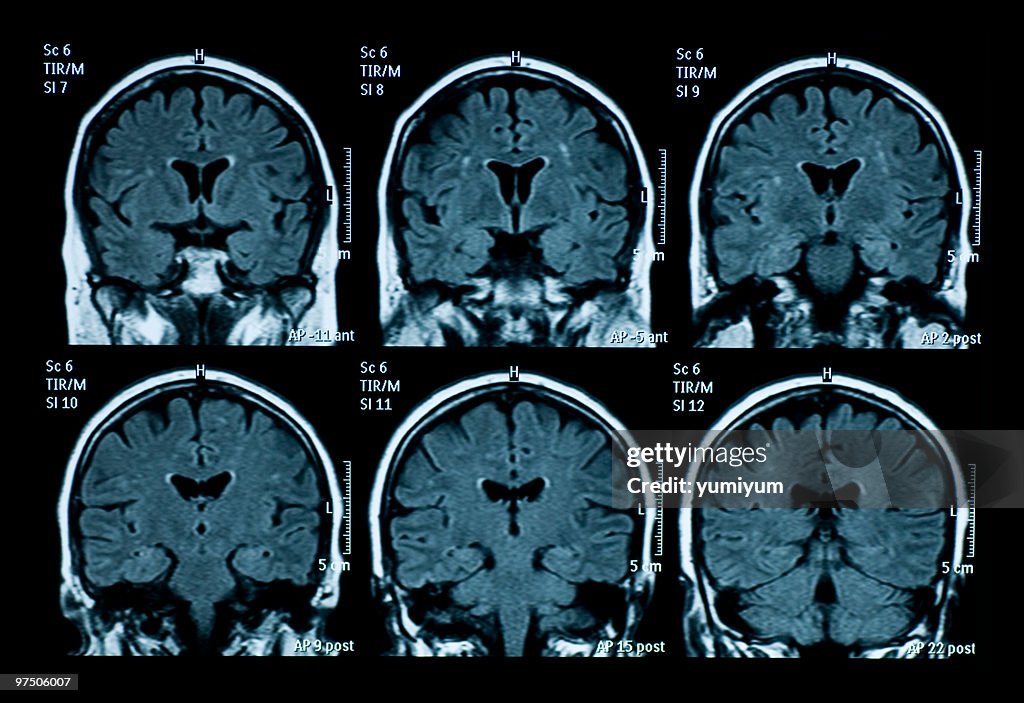 Brain Mri Scan Example Mri Scan Of Brain High-Res Stock Photo - Getty Images
