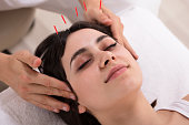 Woman Receiving Acupuncture Treatment