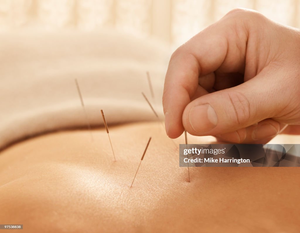 Accupuncture