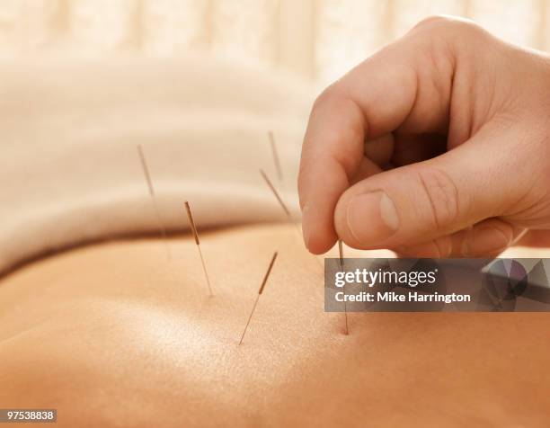 accupuncture - acupuncture stock pictures, royalty-free photos & images