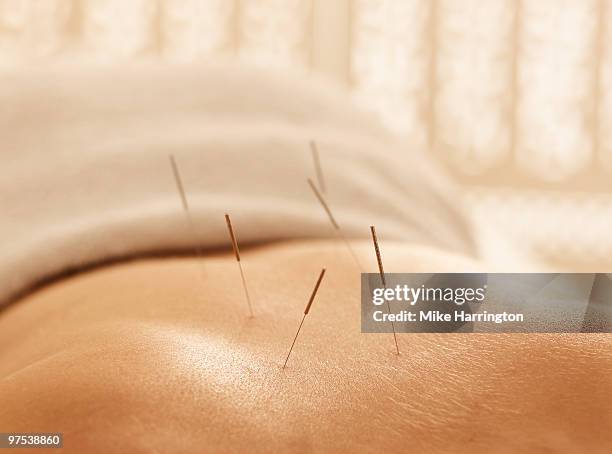 accupuncture - acupuncture needle 個照片及圖片檔