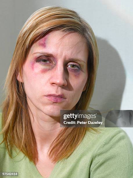 35yr old woman after domestic violence - black eye stockfoto's en -beelden