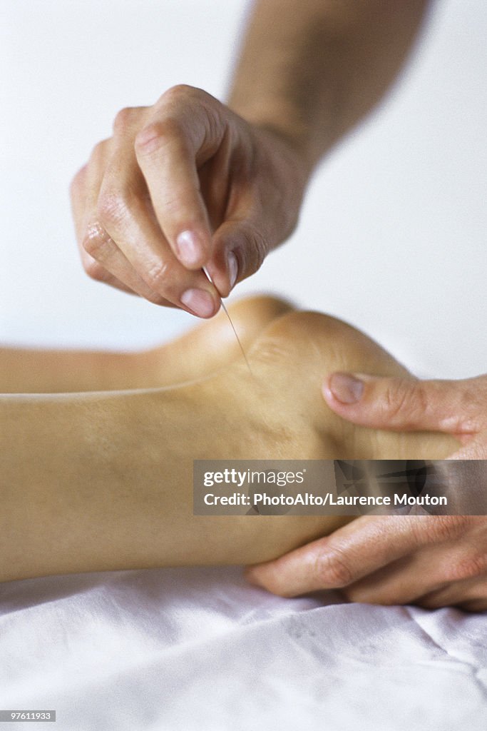 Acupuncture needle being inserted in patient's ankle