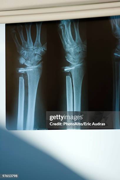 x-ray displaying injured radius and ulna - 橈骨 ストックフォトと画像