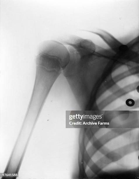 An x-ray of a shoulder, ca.1910.